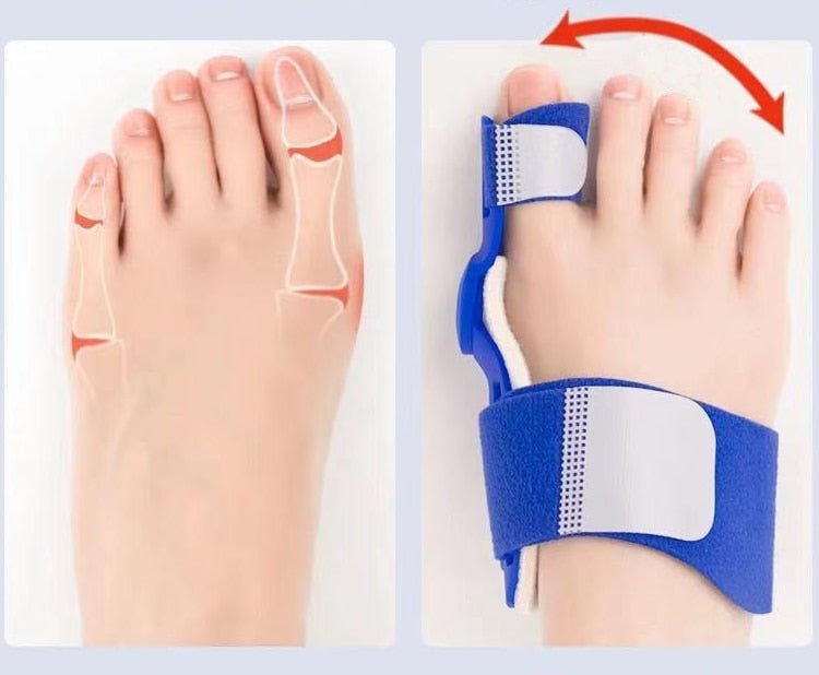 Big Toe Corrector - Flamin' Fitness